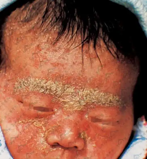 脂溢性皮炎儿童患者症状图片(面部)