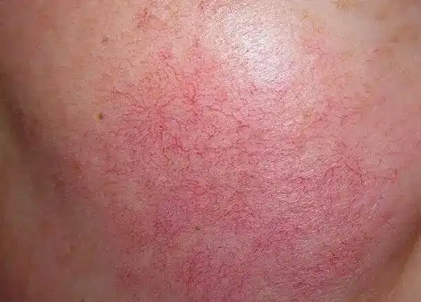 朵嘉浓秀秀护肤老师解析红血丝形成的症状反应及治疗方案