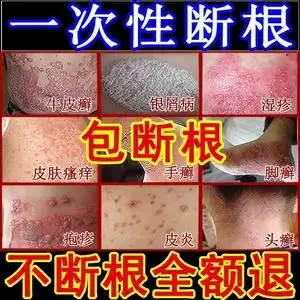 治疗皮藓的药膏