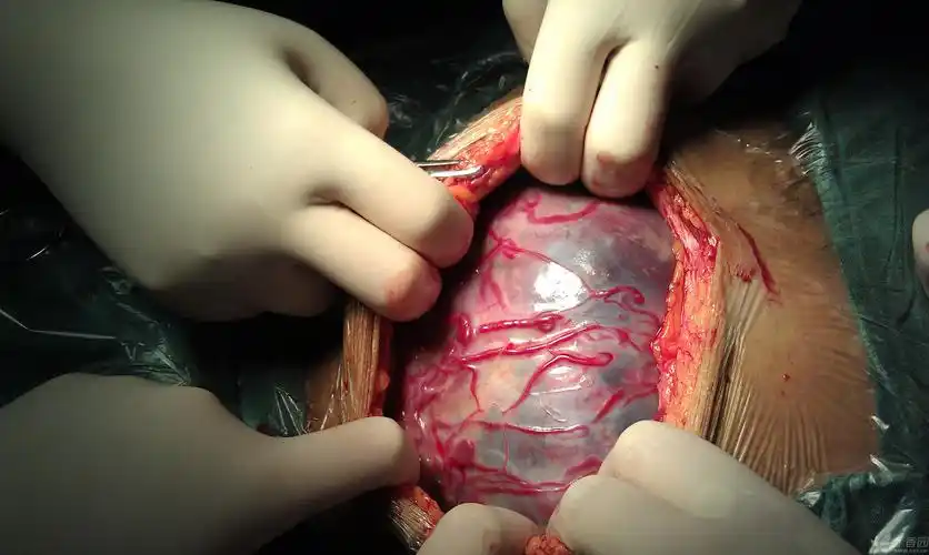 【资源】凶险性前置胎盘图片