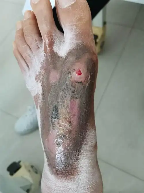 传统中医药治疗皮肤坏死一例