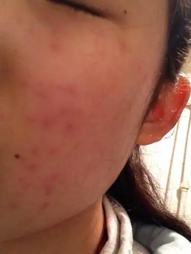 脸部过敏起的痘痘会不会流疤