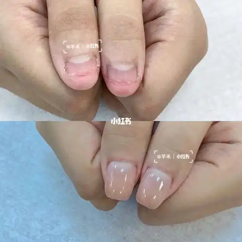 咬指甲修复