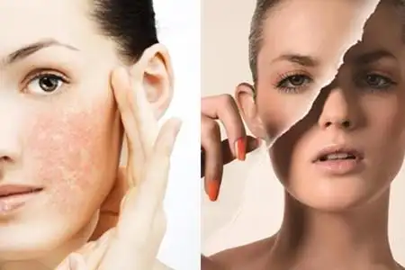 【图】详述皮脂膜受损的症状 肌肤屏障损伤原因探究