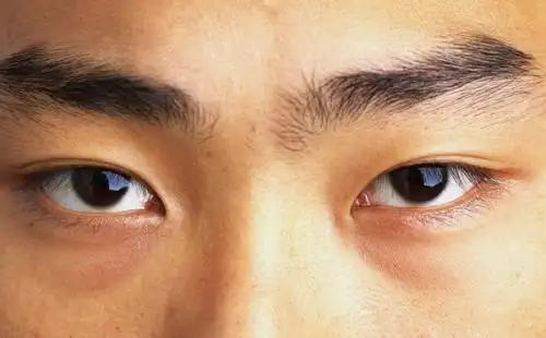 男士眼袋浮肿怎么办?