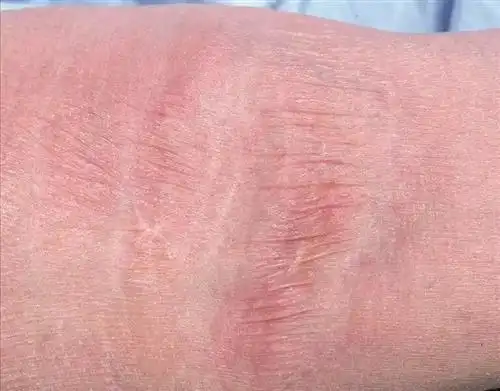 萎缩纹多久后会淡化?