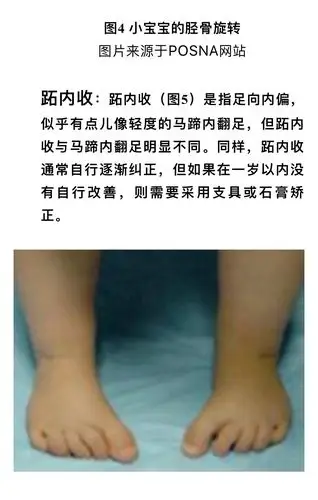 孩子走路"内八字"是怎么回事儿? - 好大夫在线