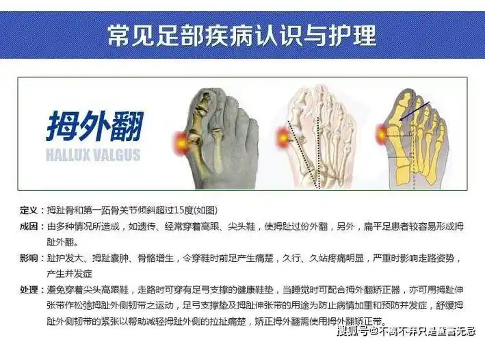 处内翻成角,也可能是大脚骨疾病发病的易发因素之一,尤其在青少年拇
