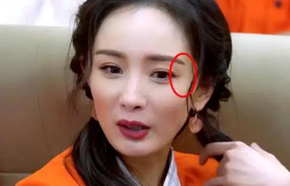 杨幂眼角伤疤首曝光!4厘米疤痕化妆都遮不掉,曝刚缝美容针300针