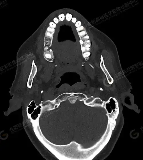 术前检查头颅ct平扫发现"颅底凹陷症"1例_测量_枕骨_形态