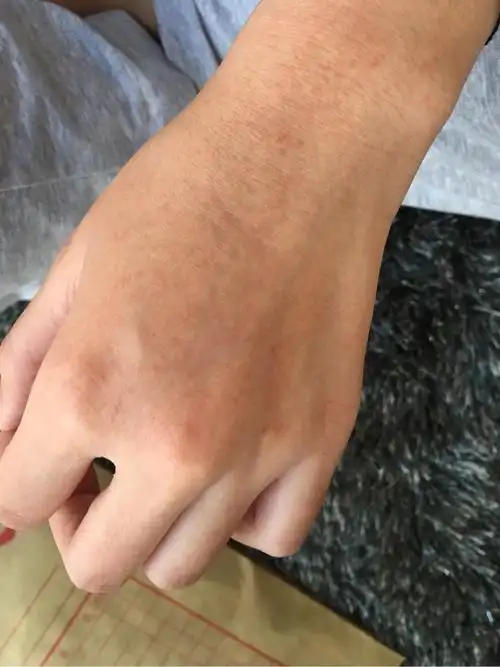 宝妈们芒果过敏吗