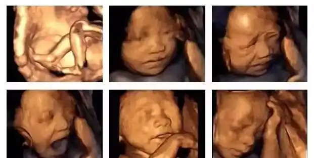胎儿四维照片丑哭,生出来会不会丑?知道原因后,孕妈可以放心了