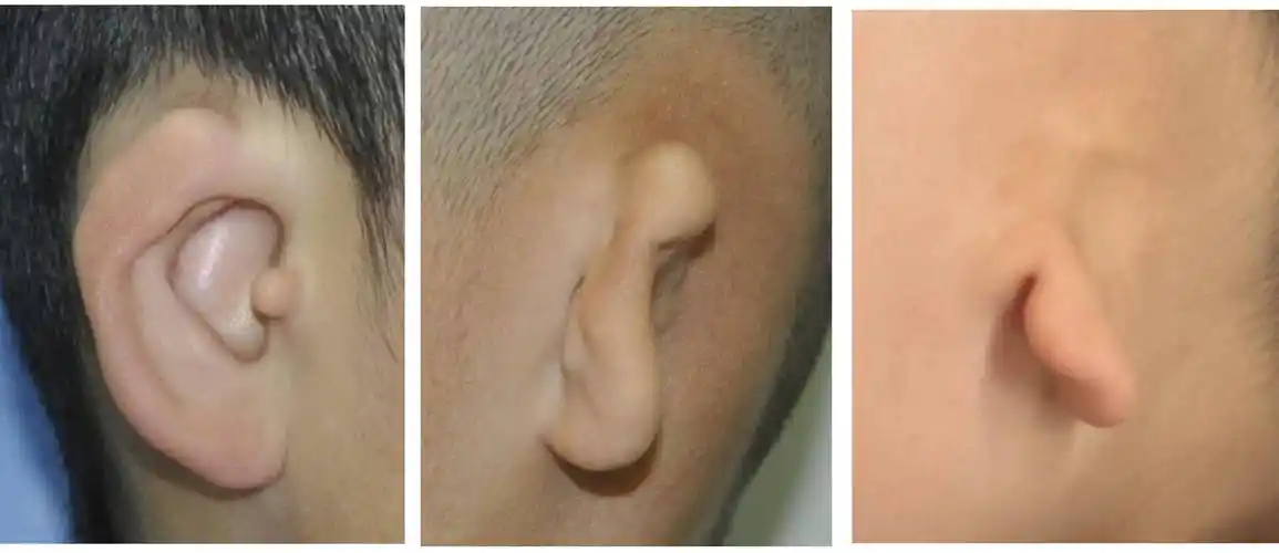 全国爱耳日 | 外耳畸形何时矫正?哪种情况需要做手术?_耳廓_矫治_形态