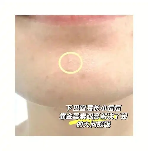 超级好用的金霉素眼膏解决了大问题