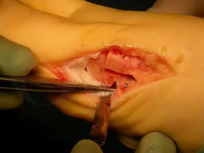 大脚骨手术要截骨可以不用截骨吗听着吓人