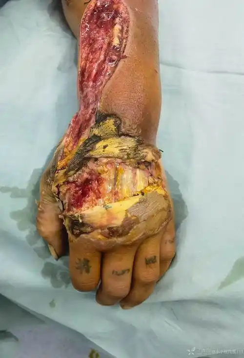 蛇咬伤皮肤皮下组织坏死治疗分享