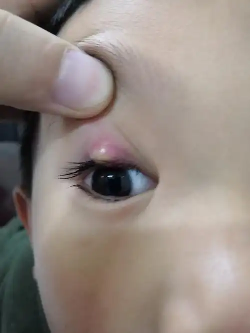 睑腺炎俗称麦粒肿中医名针眼的个人经验治疗