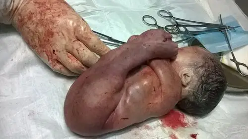 【讨论】并腿综合症