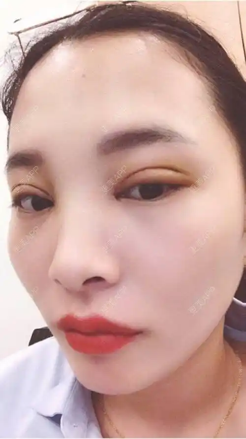 更美用户koiddfv100的全切双眼皮日记