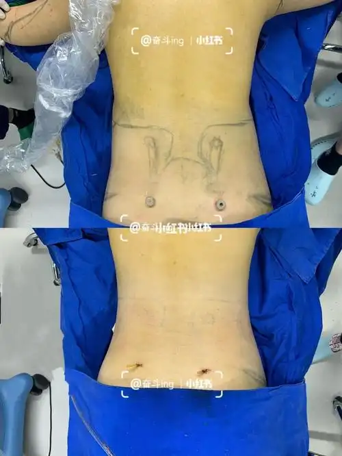 威力雕塑腰腹环吸