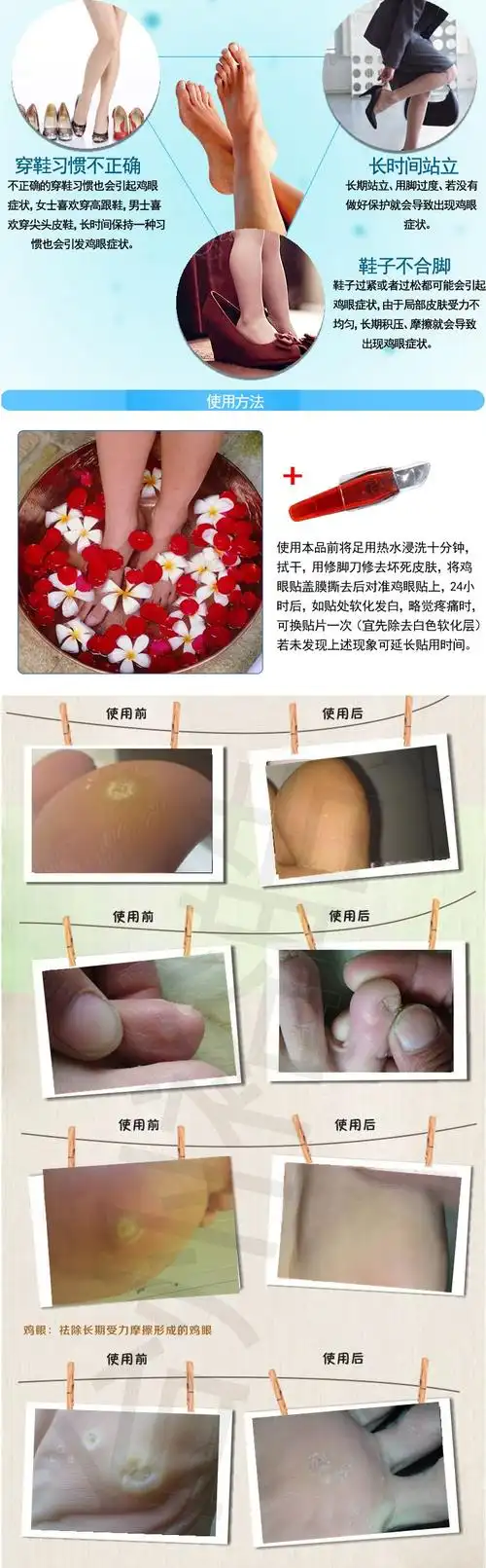 鸡眼贴30贴去除老茧刺瘊刺窝脚钉脚茧脚垫贴膏除茧贴