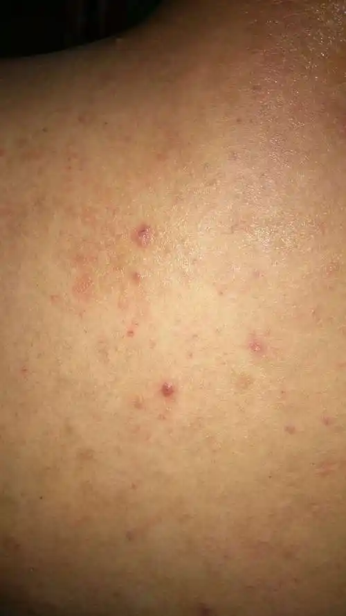 背上长了很多痘痘药店医生说是毛囊炎很痒买了药摸了一段时