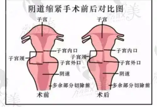 阴道紧缩手术前后示意图
