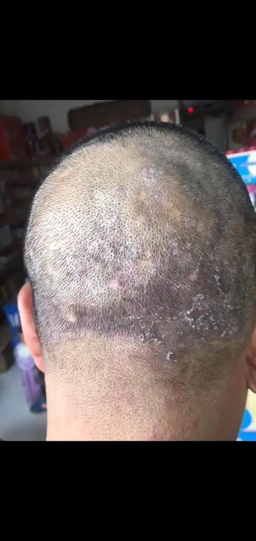 94 春天干性头屑满天飞 越挠越痒越多怎么办?