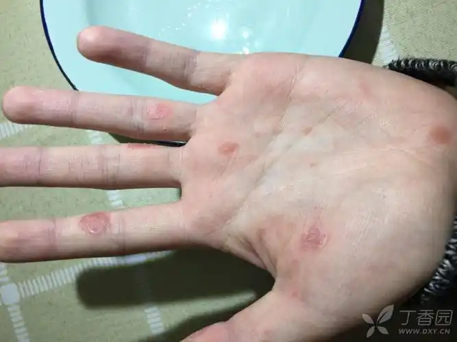 手足都有,不痛不痒.发病三周,还在新发疹子.求问什么病?