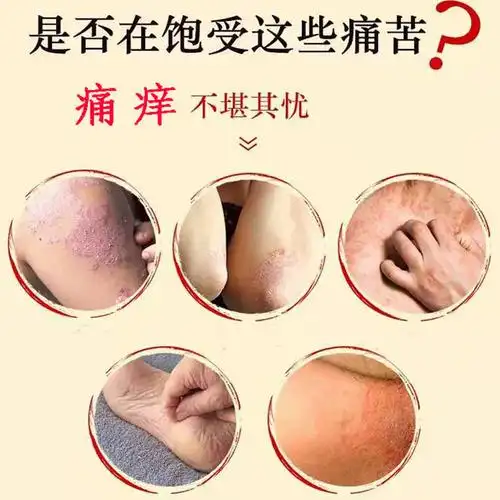 肛门瘙痒潮湿肛周脓肿屁眼男性皮肤阴囊屁股皮肤消毒护理(消)