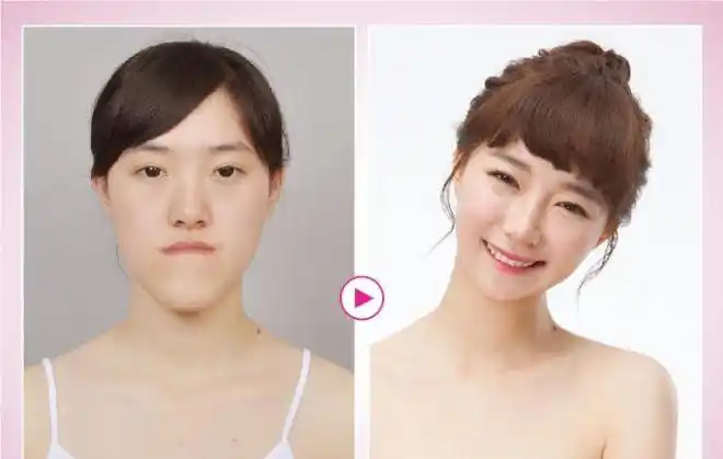 直击中国女子赴韩国整容2个月从丑女变成了大美女