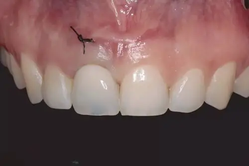 上颌中切牙即刻种植一例