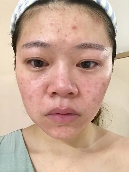 对抗敏感 修复受损角质层(附过敏前后哦对比图)