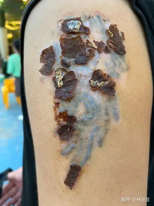 洗纹身恢复过程