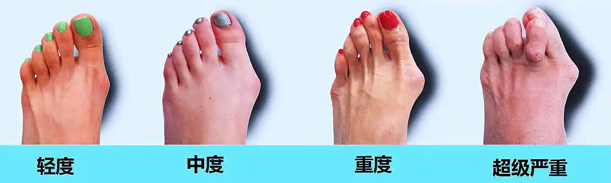 北京丰台广济医院科普:您知道的拇外翻的那些事儿_大拇趾_脚趾_脚掌
