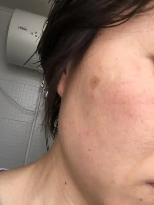 怀孕后长的斑,十年了面积越来越大,请问这是什么斑?该如何治疗?