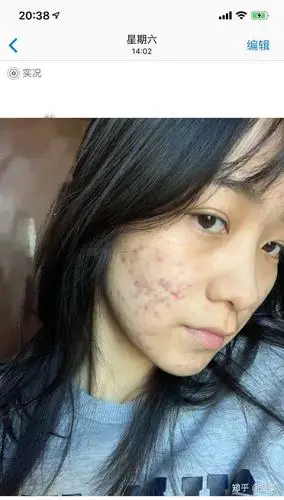 五官好看,皮肤差是种怎样的体验?