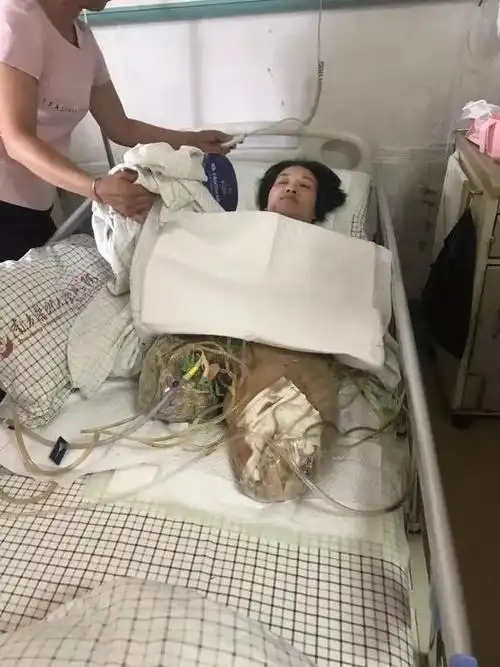 进行了双腿高位截肢,在乐从医院icu监护了十一天,做过两次清创手术