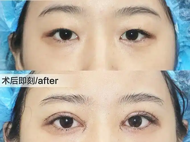 术前分析:顾客术前有轻度的上睑下垂,眼间距比较宽,想要自然灵动点的