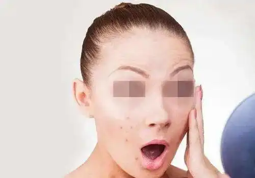 【科普】为什么有的人一熬夜就长痘?