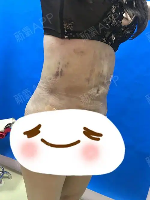 做完水动力腰腹环吸脂已经有7天了!姐妹们!