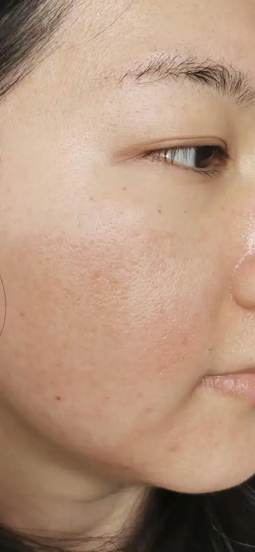 co2点阵激光祛痘坑收缩毛孔连载