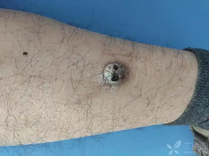 右小腿屈侧肿物1年余 [病例帖]