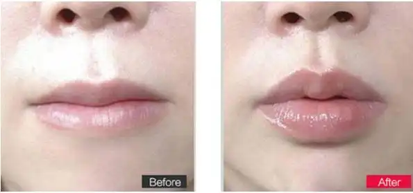 玻尿酸丰唇拥有嘟嘟唇很简单