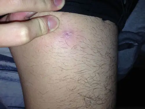 今天刚发现大腿上长了个硬疙瘩 不痒 但是坐在上面的话会有点痛