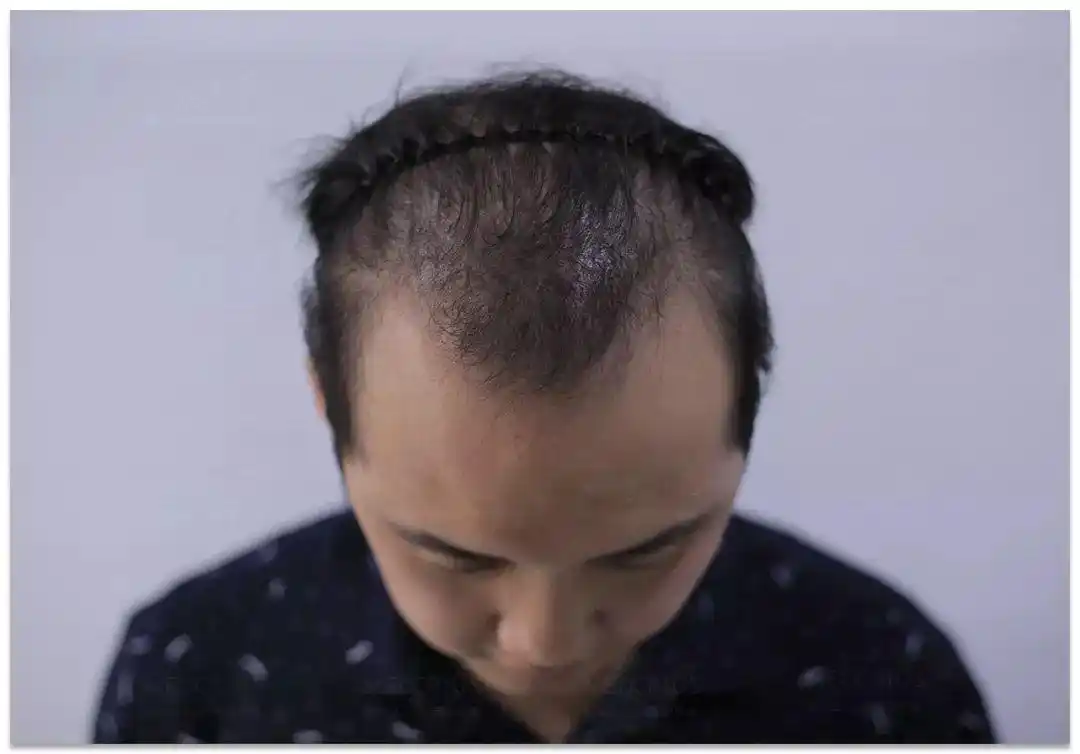 90后秃顶医疗从业者的脱发自救指南脱发到底该如何治疗