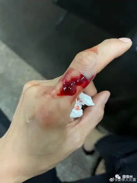 宿州女子远嫁异乡惨遭家暴举着血淋淋的手指求助