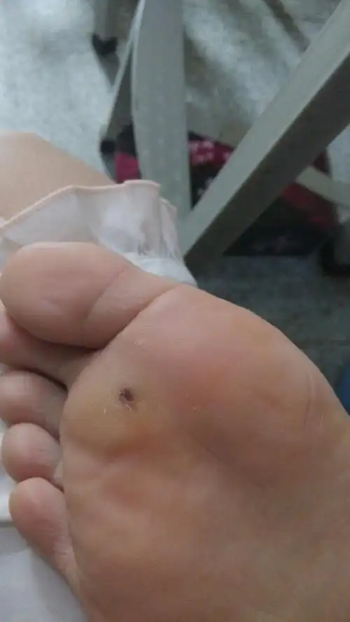 脚底茧子变黑,是怎么了?