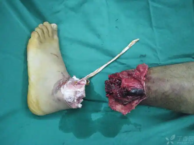 27岁男子左脚被钢丝割断 医生紧急手术再植成功 [病例帖]