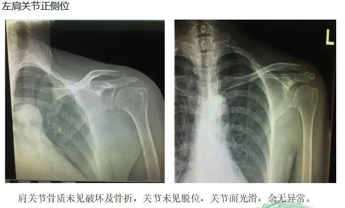 一例继发性肩部功能障碍患者u000b原因分析与康复对策相关讨论